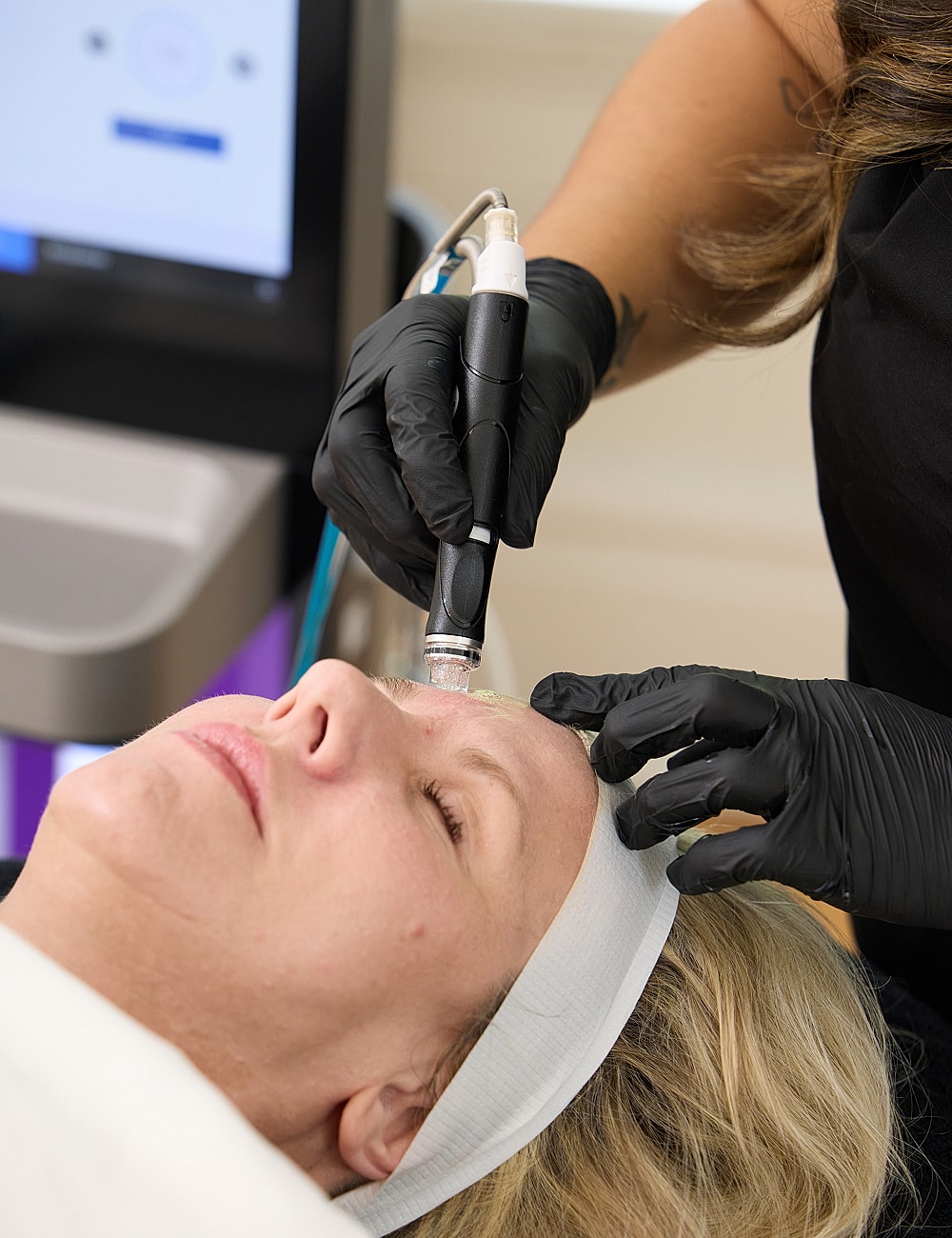 Microneedling treatment being performed on a client.