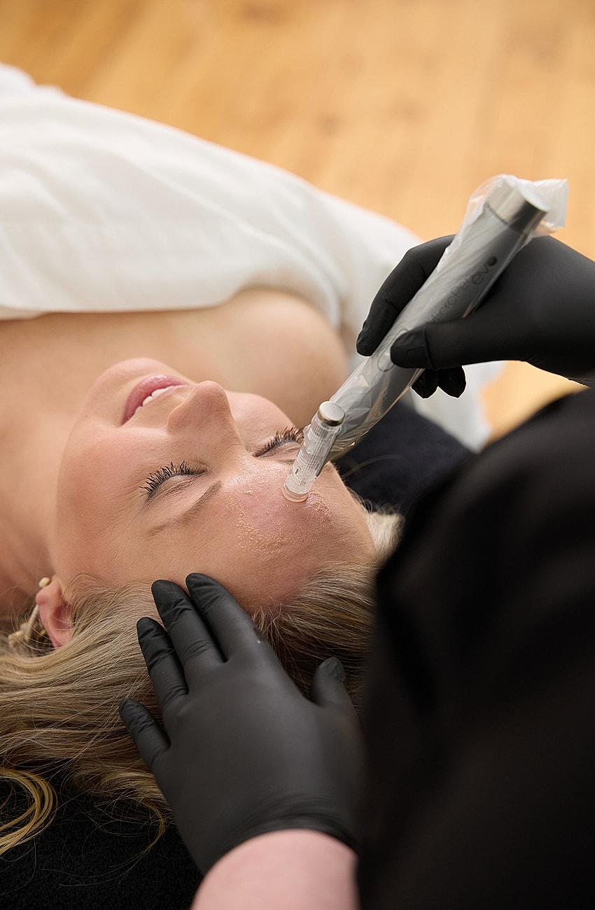 Microneedling treatment session in progress.