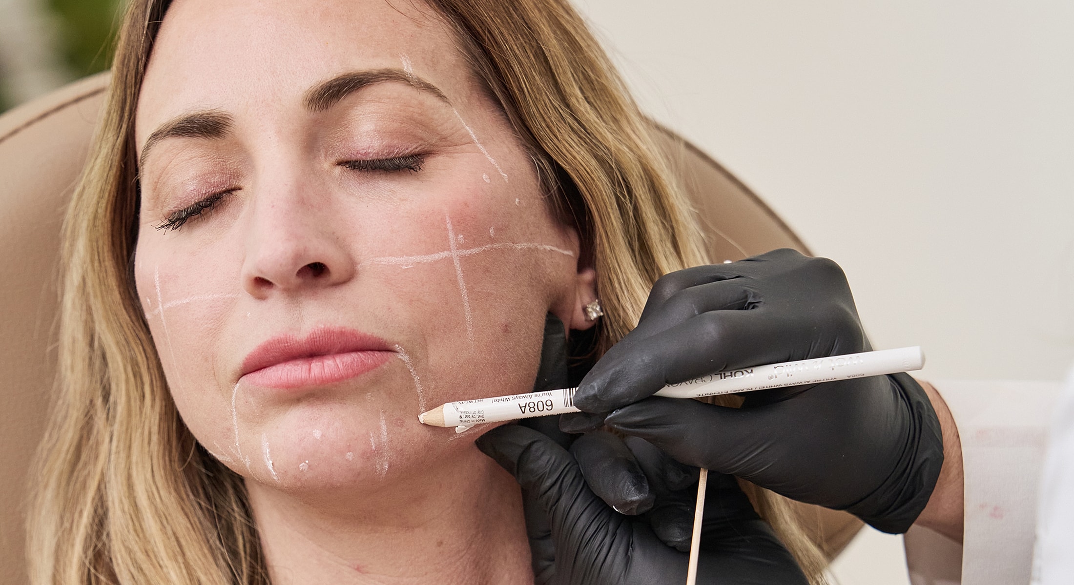 Facial marking for cosmetic procedure preparation.