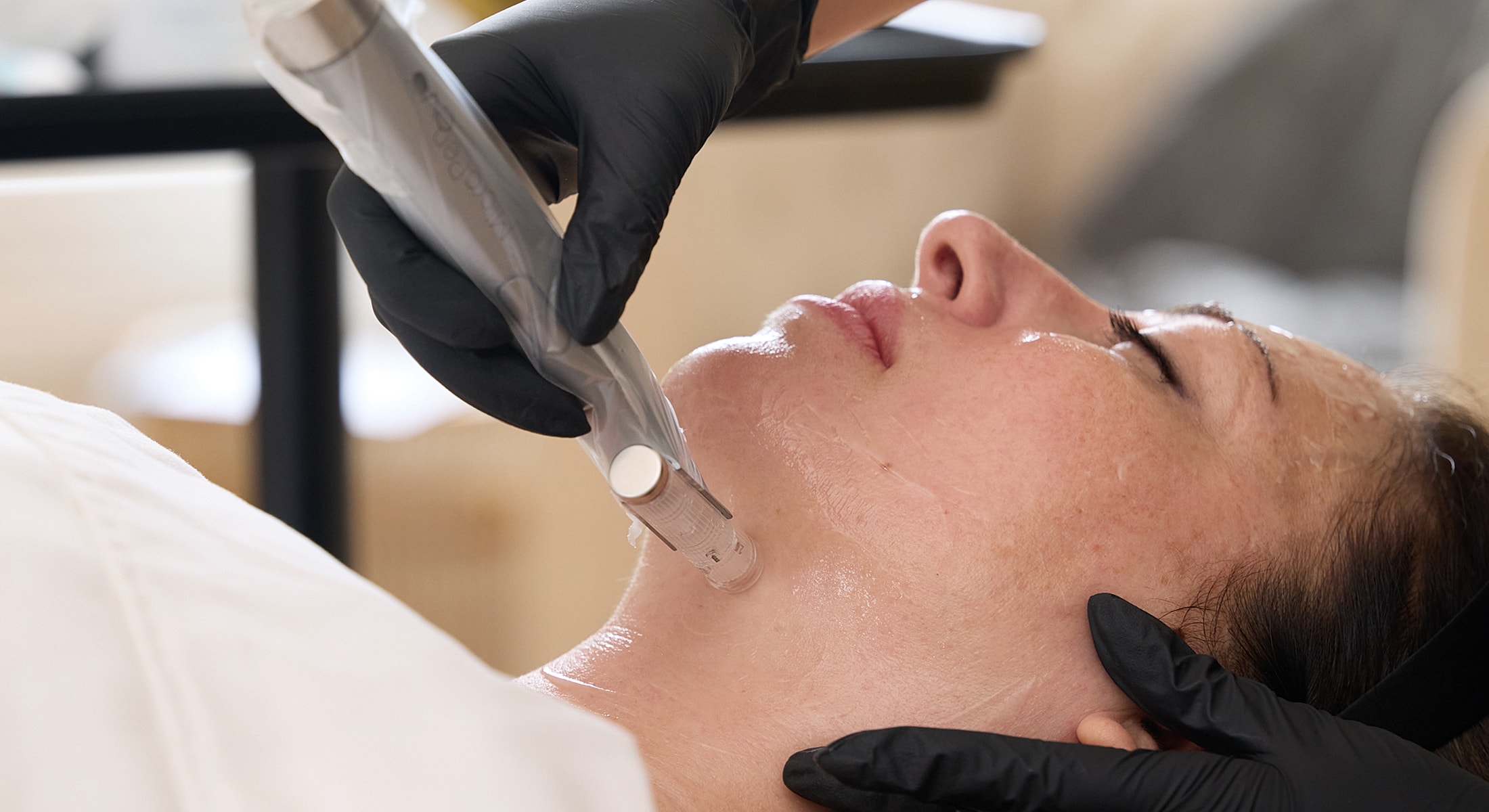 Microneedling treatment on a woman's face.